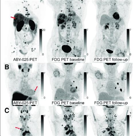 68 Ga Ga ABY 025 PET CT And 18 F F FDG PET CT Images At Baseline