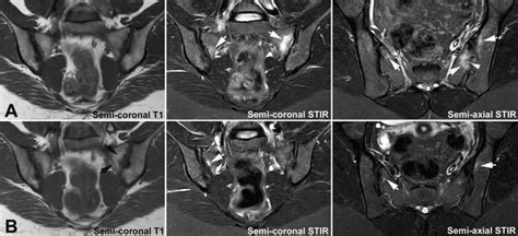 Individual Evolution Of Sacroiliac Joint Magnetic Resonance Imaging Download Scientific Diagram