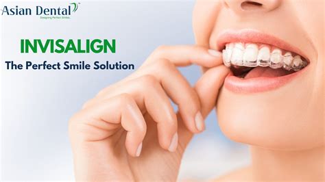 Best Invisalign Invisible Braces Treatment In Hyderabadbest Invisalign Invisible Braces