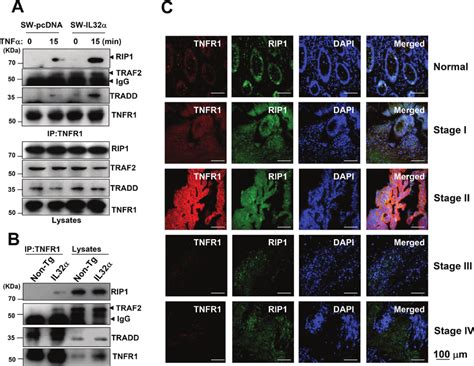 Effect of IL 32α on TNFR1 adaptor complex in colon cancer development