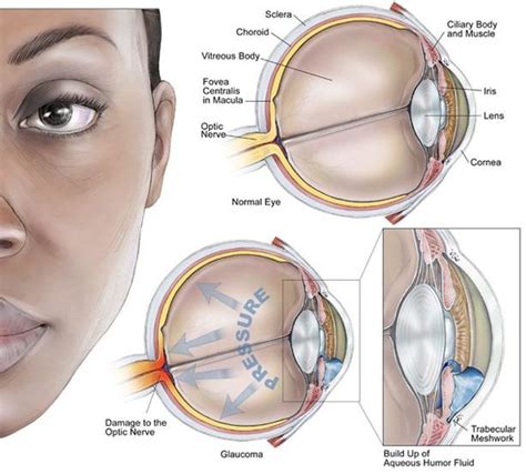 Normal Tension Glaucoma