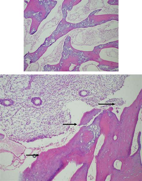 A Histopathologic Examination Of Endometrial Curettings Showed Bone