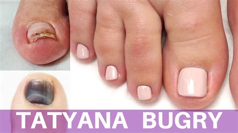 How To Fix Damaged Toenails At Josephine Szymanski Blog