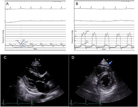 Right Heart Failure With Recurrent Pericardial Effusion Mimicking