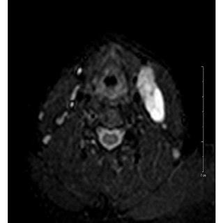 X Ray Neck Lateral View Showing Air Fluid Level In Enlarged Cyst Of