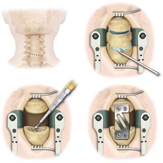 (PDF) Cervical Corpectomy, Fusion, and Vertebral Restoration Techniques