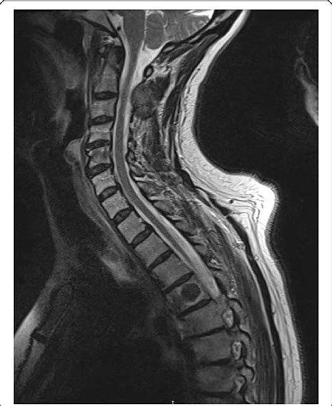 T2 Weighted Sagittal Magnetic Resonance Image Demonstrating The