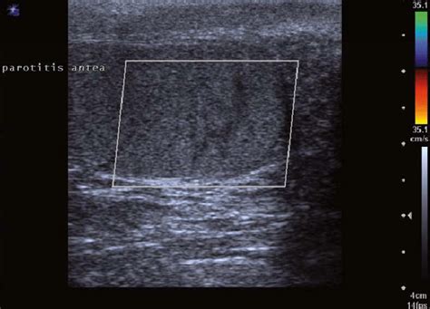 Ultrasound print of the testis from a patient with previous parotitis... | Download Scientific ...