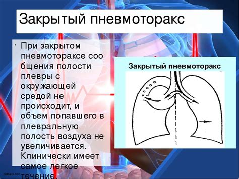 пневмторакс - презентація з медицини