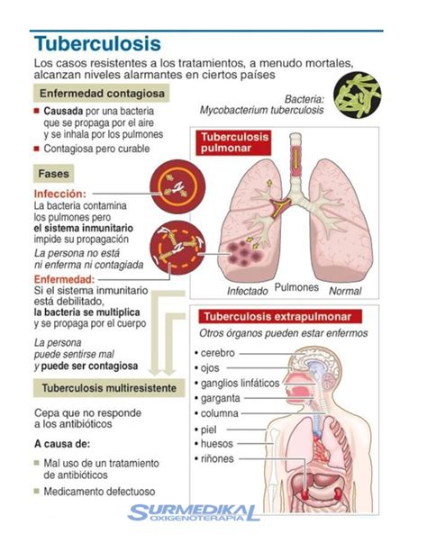 Tuberculosis sobre los pulmones para Biología Studocu