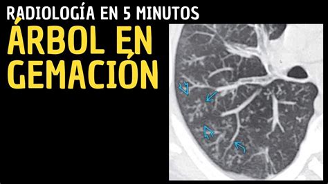 Radiolog A En Minutos Signos Radiol Gicos Pulmonares Rbol En