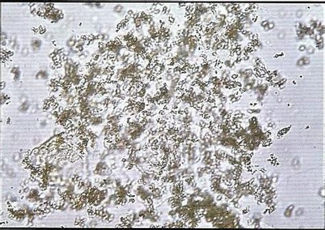 Fun Quiz: Urine Sediments - The Mislabeled Specimen