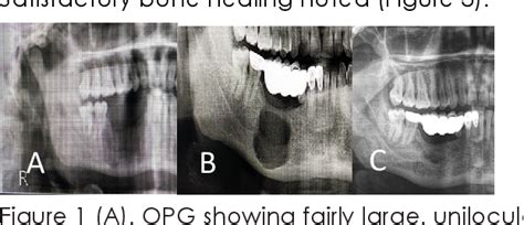 Figure From Conservative Management Of Unicystic Ameloblastoma A