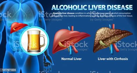 Informative Poster Of Alcoholic Liver Disease Cirrhosis Stock