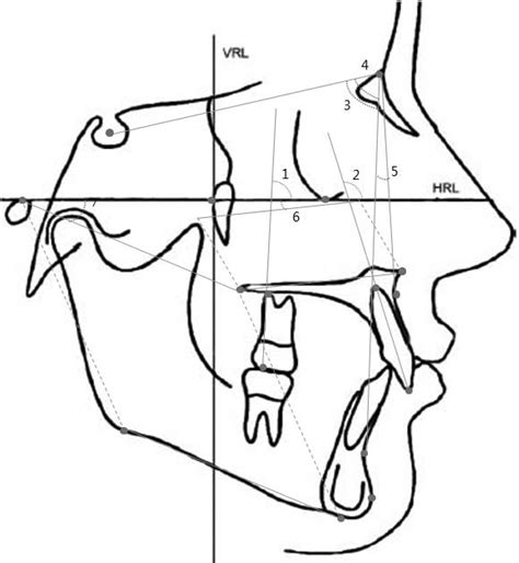 Angular Measurements 1 Maxillary First Molar To Fh Plane Angle 2 Download Scientific