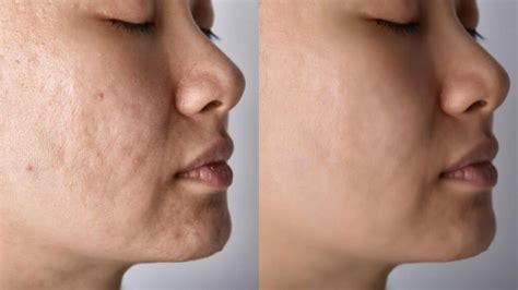 Effective Hormonal Acne Treatment In Los Angeles My Concierge Md