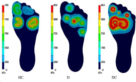 Plantar Pressure Distribution Across The Hc D And Dc Group During