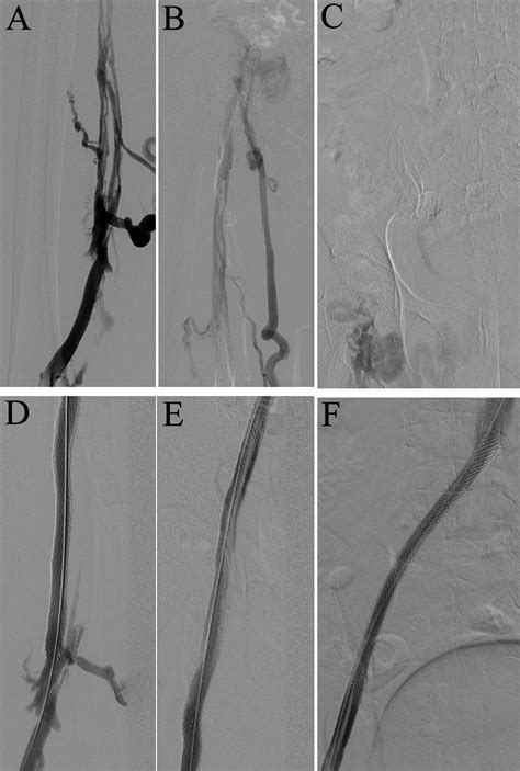 Treatment Of Femoral Vein Obstruction Concomitant With Iliofemoral