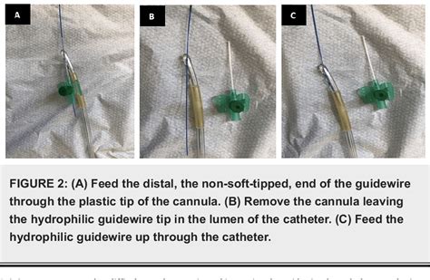 Figure 2 From An Easy Solution For Difficult Urethral Catheter Three Way Urethral Catheter