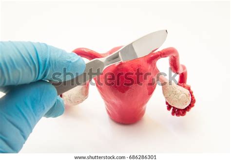 Fallopian Tube Surgery Treat Infertility Ectopic Stock Photo 686286301 ...