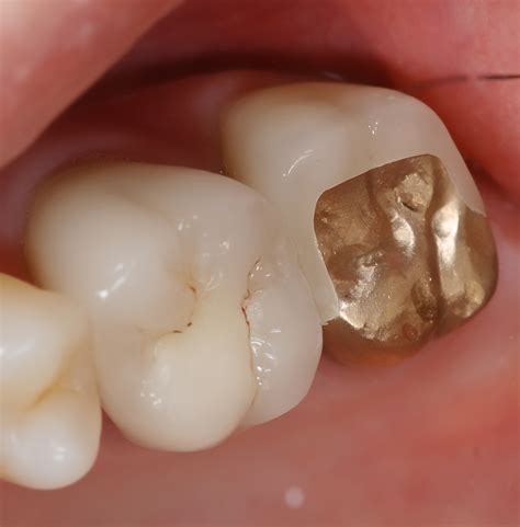 Gold Onlays Rick Glassman Dds Maafe