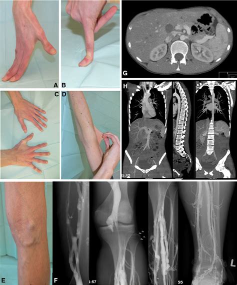 Vascular Ehlers Danlos Syndrome