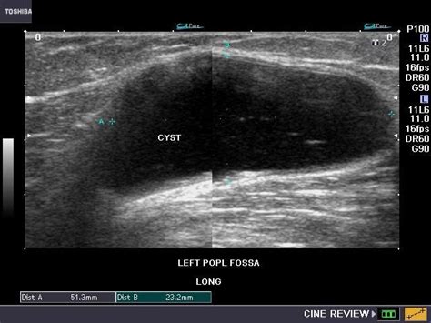 Cochinblogs Baker Cyst And Other Musculoskeletal Ultrasound Cases