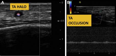 Evaluation of Temporal Artery Duplex Ultrasound for Diagnosis of Temporal Arteritis - Journal of ...