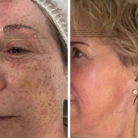 Fraxel Laser Treatment London And Surrey Dr H Consult