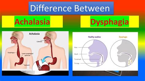 Difference Between Achalasia And Dysphagia YouTube