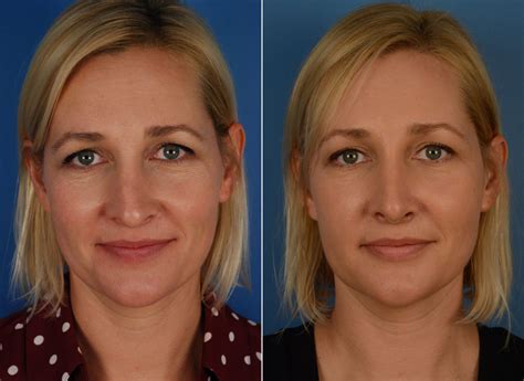 Revision Rhinoplasty Photos Naples Fl Patient 11827