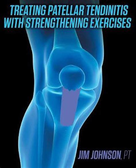 Treating Patellar Tendinitis With Strengthening Exercises Walmart