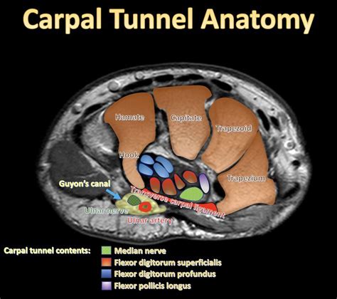 Carpal Tunnel Wikism Sports Medicine Wiki