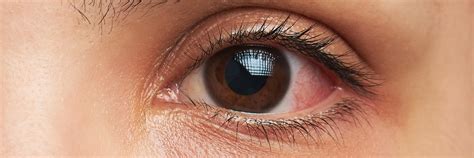 The Most Common Eye Infections