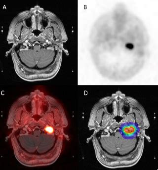 Pet Ct Provides Superior Lesion Detection For Head And Neck