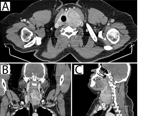 Figure 3 From Coexistence Of Oncocytic Hürthle Cell Carcinoma With Foci Of Anaplastic