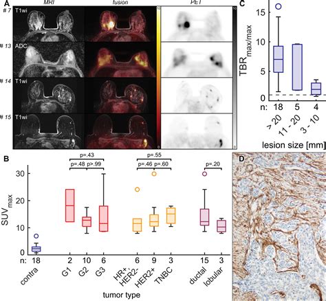 Simultaneous FAPI PET MRI Targeting The Fibroblast Activation Protein