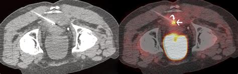 Petct Guided Percutaneous Biopsy Of Abdominal Masses Initial