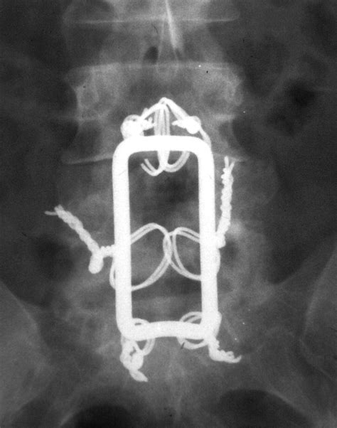 Lumbar Spine Fusion And Stabilization Hardware Techniques And