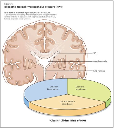 Idiopathic Normal Pressure Hydrocephalus