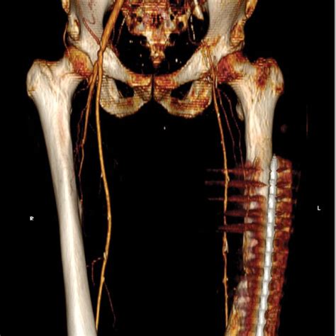 Preoperative Three Dimensional Computed Tomography Scan Reconstruction