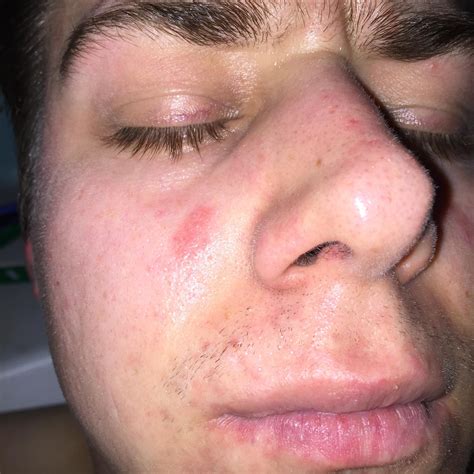 Acne Like Rashspots General Acne Discussion Forum