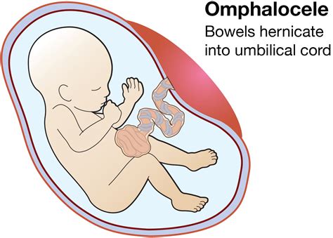 Omphalocele