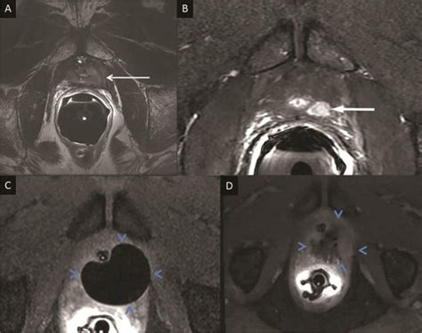 Multiparametric 3 0t Mri Panel A And B With Endorectal Coil In Place Download Scientific