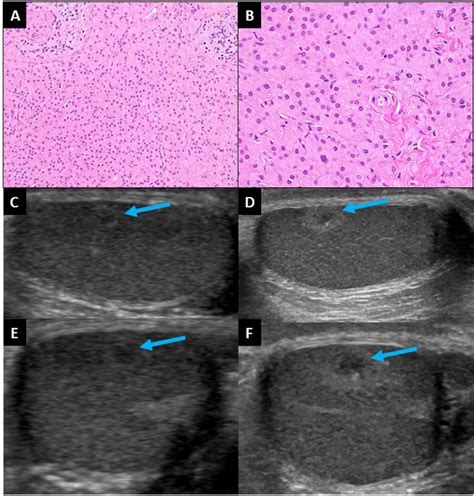 Testicular Sertoli Cell Tumour And Potentially Testicular Leydig Cell