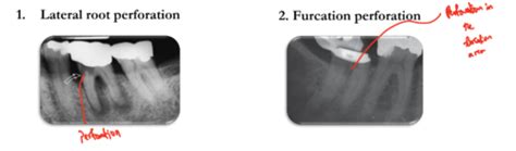 Procedural Accidents Endodontic Mishaps Flashcards Quizlet