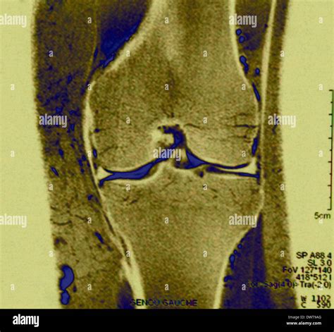 Resonancia Magn Tica De Rodilla Fotograf A De Stock Alamy