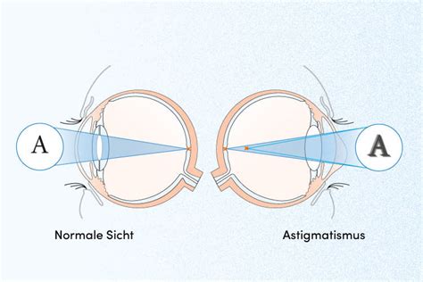Astigmatismus Hornhautverkr Mmung Einfach Erkl Rt Apollo