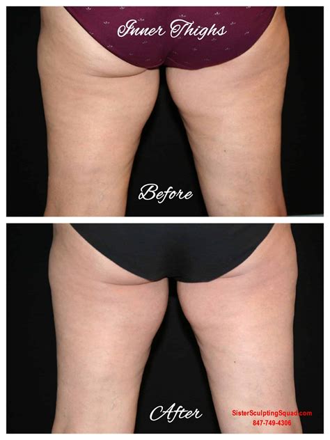 Inner Thigh Fat Before And After Atelier Yuwa Ciao Jp