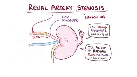 Renal Artery Stenosis Treatment Symptoms And More